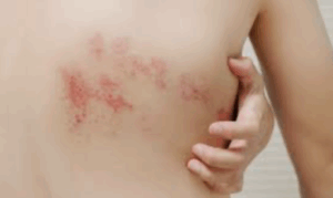 Herpes Zoster
